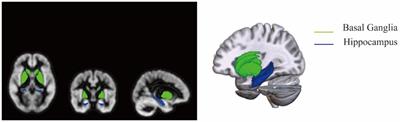 Radiomic and clinical nomogram for cognitive impairment prediction in Wilson’s disease